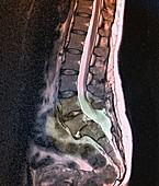 Spondylolisthesis,MRI