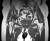 Osteonecrosis of the pelvis,MRI