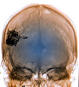 Brain blood vessel malformation,CT scan