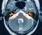 Auditory system,MRI