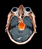 Brain aneurysm,MRI