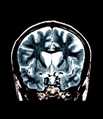 Brain in Huntington's disease,MRI