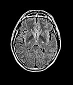 Brain in motor neurone disease,MRI
