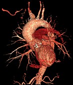 Aortic aneurysm in hypertension,CT scan