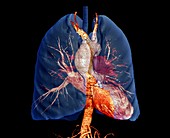 Aortic aneurysm in hypertension,CT scan