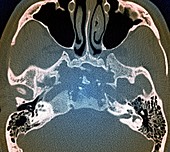 Skull in Erdheim-Chester disease,MRI