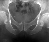 Benign prostatic hyperplasia,MRI