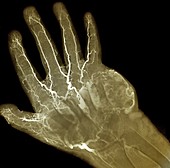 Hand tumour,X-ray