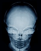 Congenital hypothyroidism,X-ray