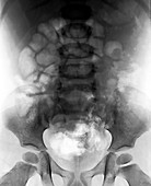 Intussusception of the intestines,X-ray