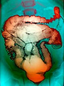 Intussusception of the intestines,X-ray