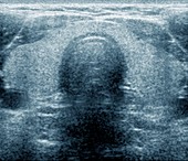 Normal thyroid gland,ultrasound