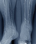 Arteritis in diabetes,X-ray