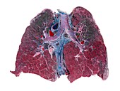 Lung silicosis