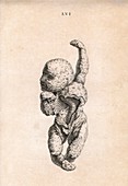 Human foetus,historical illustration