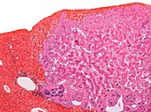 Metastatic bone cancer,light micrograph