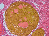 Metastatic liver cancer,light micrograph