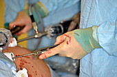 Endoscopic bariatric surgery