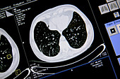 Axial lung CT scan
