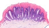 Skin wart,light micrograph