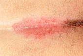 Flexural psoriasis of a buttock cleft