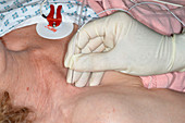 Brachial plexus nerve block