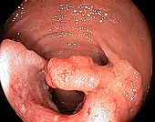 Rectal cancer,endoscope view