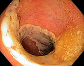 Ischaemic colitis,endoscope view