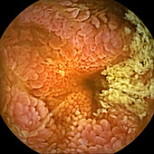 Crohn's disease,capsule endoscopy