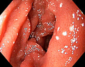 Lymphangiectasia in the duodenum