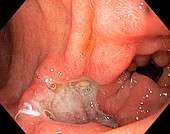 Prepyloric stomach ulcer,endoscope view