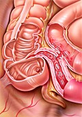 Crohn's disease,illustration