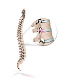 Spinal disc prolapse,illustration