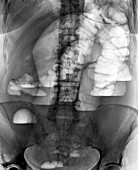 Abdominal blockage,X-ray