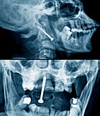 Pinned broken neck,X-ray