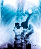 Gastric ring,X-ray