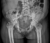 Osteonecrosis of the hip,X-ray