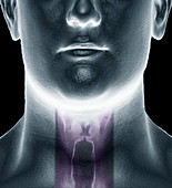 Vocal cords,composite 3D image