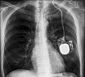 Parkinson's brain pacemaker,X-ray