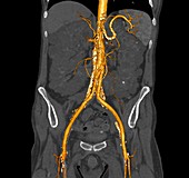 Retroperitoneal fibrosis,3D CT scan