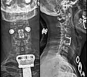 Herniated spinal disc after treatment