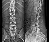 Fixed spinal fracture,X-ray