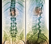 Fixed spinal fracture,X-ray