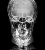 Road accident facial trauma,X-ray