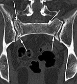 Fractured pelvis,CT scan