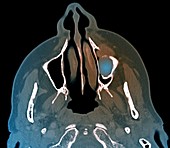 Giant cell granuloma of the jaw,CT scan