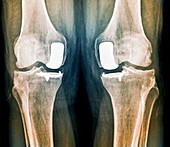 Partial knee replacement,X-ray