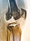 Partial knee replacement,X-ray