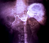 Spleen abscess,X-ray