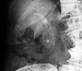 Gallstones,X-ray